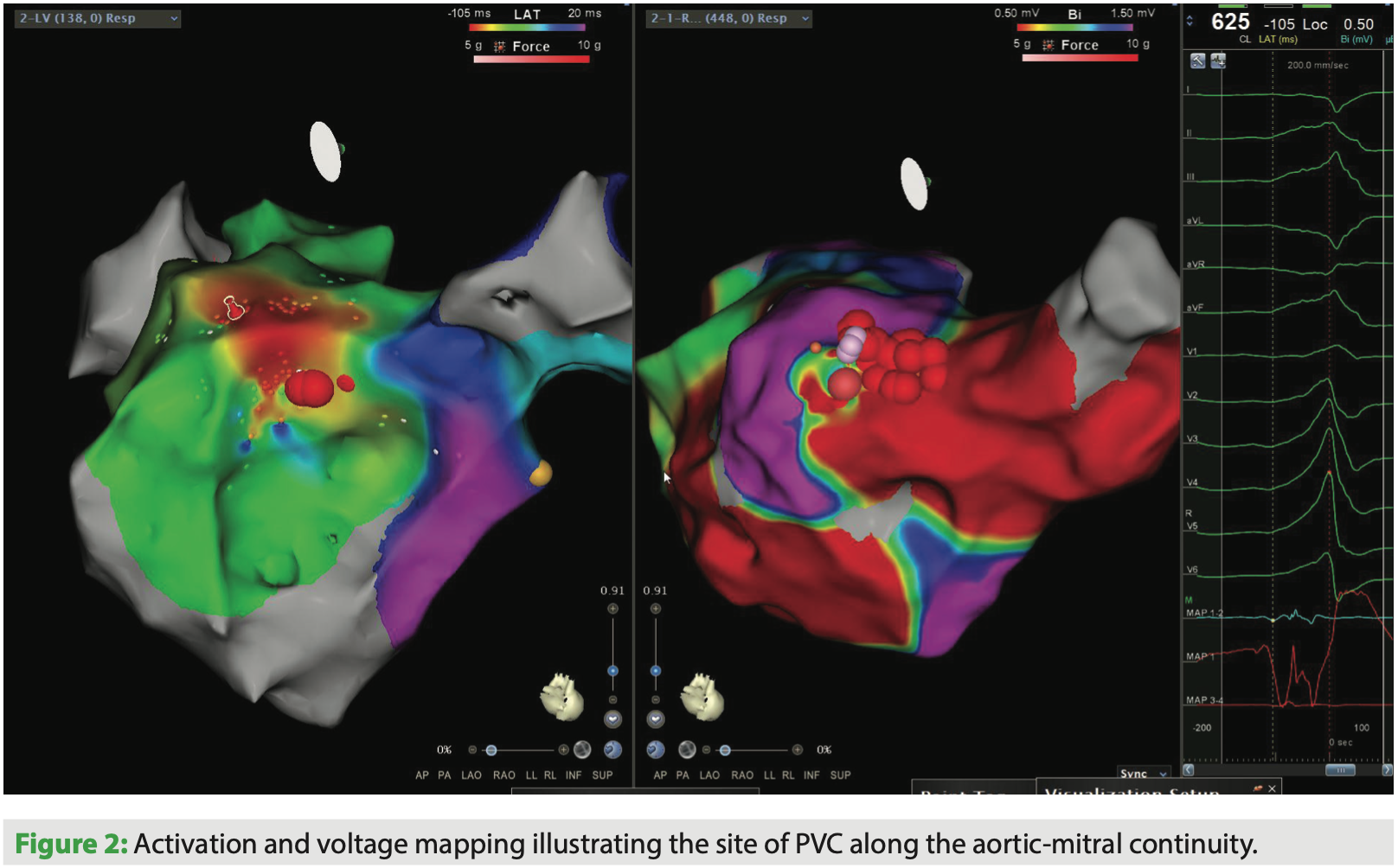 PVCs and the Role of Catheter Ablation in Current Times EPLD